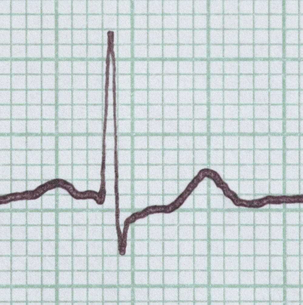 ekg